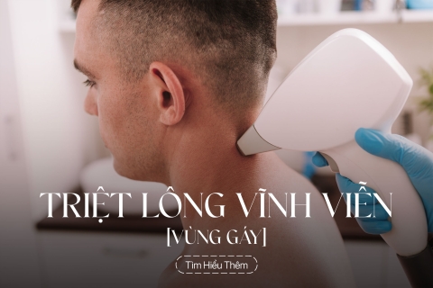 Triệt lông vùng gáy vĩnh viễn